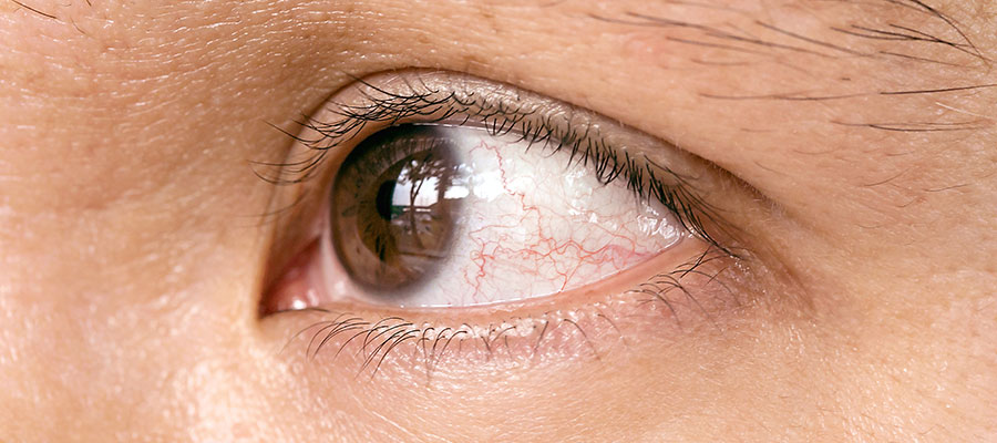 Viele an Allergien. Rote Augen oder gerötete Augen - besonders im Frühjahr und Sommer leiden Viele an Allergien. 