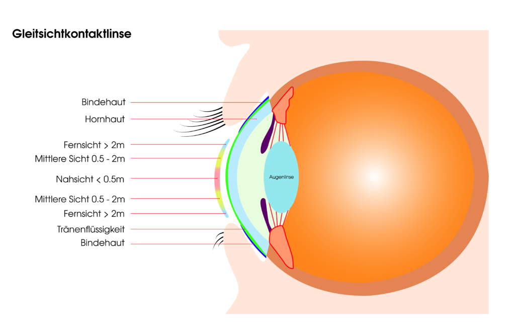 Multifokale Kontaktlinsen erklärt 