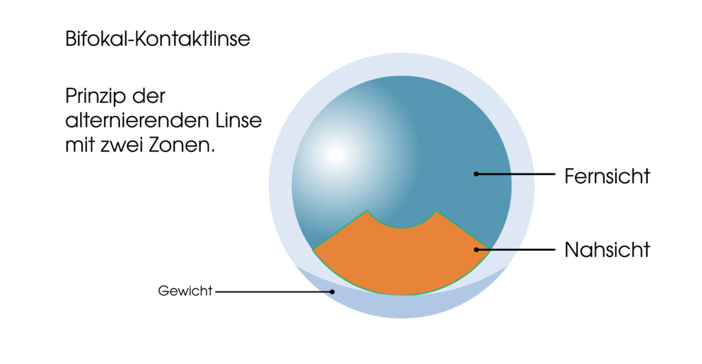 Bifkokalkontaktlinsen erklärt