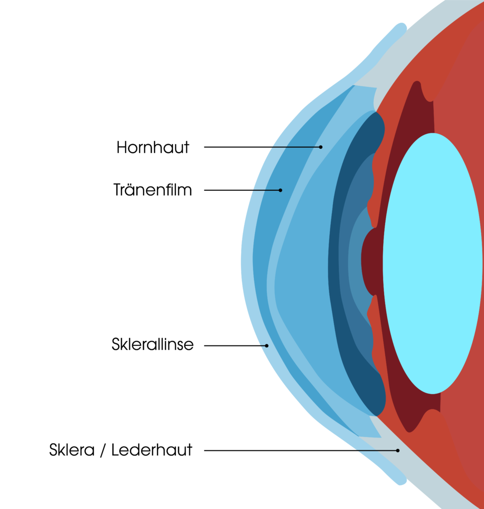 Die Handhabung von Sklerallinsen unterscheidet sich von der herkömmlicher Kontaktlinsen.