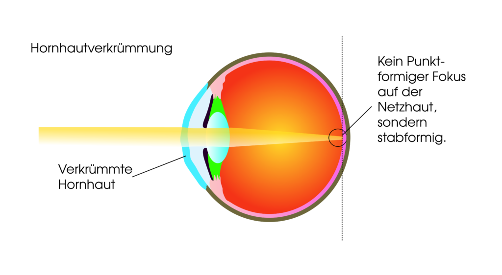 Torische Kontaktlinsen zur Korrektur einer Hornhautverkrümmung