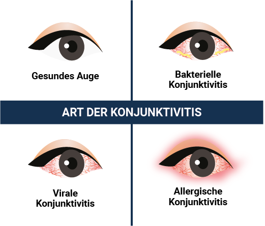 Arten der Konjunktivitis beim Auge - Bindehautentzündung